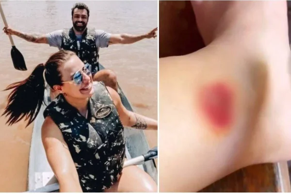 Influenciadora choca ao mostrar, sem censura, mordida de piranha
