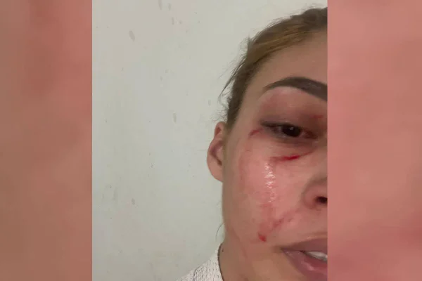 Lesões em mulher que acordou com homem de cueca em cima dela - Metrópoles