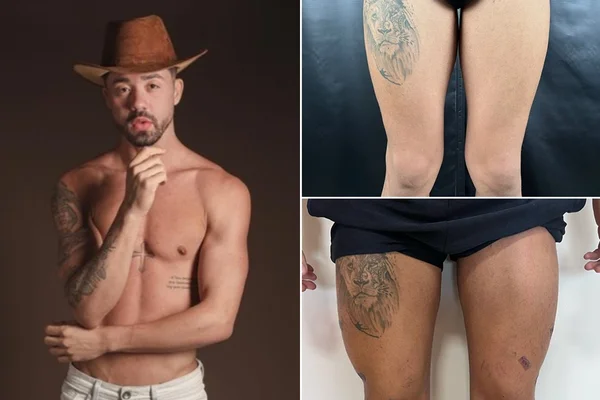 Rico Melquiades faz procedimento estético nas coxas e no bumbum (Reprodução)