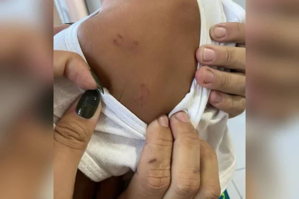 imagem colorida bebe mordida em creche rj