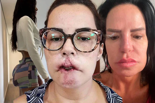 Vítimas do PMMA: mulheres relatam dor e arrependimento após a técnica