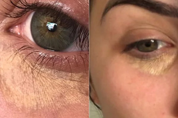 Influenciadora fica com manchas no rosto após tentar camuflar olheiras