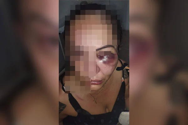 Imagem colorida de uma mulher com o olho machucado - Metrópoles