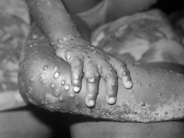 Vista da mão direita e da perna direita de uma menina de 4 anos em Bondua, condado de Grand Gedeh, Libéria, que revela numerosas lesões maculopapulares da varíola dos macacos - Metrópoles