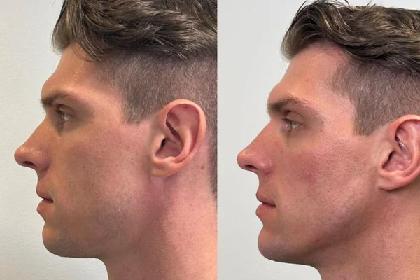 Ex-BBB23 Cristian Vanelli faz harmonização facial. Saiba o valor