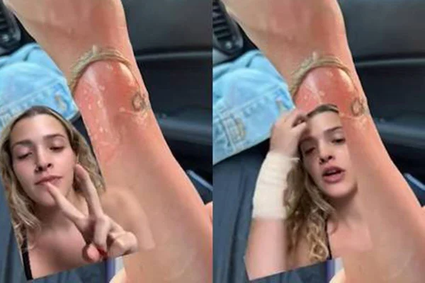 Montagem com dois frames coloridos de uma menina loira com o pulso enfaixado falando com uma foto de um braço queimado ao fundo - metrópoles