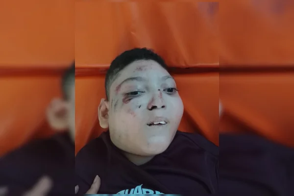 Menino cadeirante cai de escada rolante no Metrô-DF e vai parar na UTI