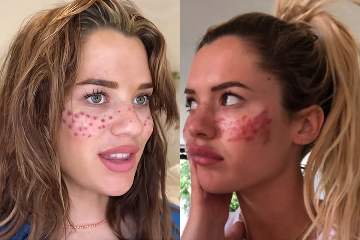 Influenciadora australiana vai ao hospital após tatuar sardas em casa - estilo de vida news from Metrópoles