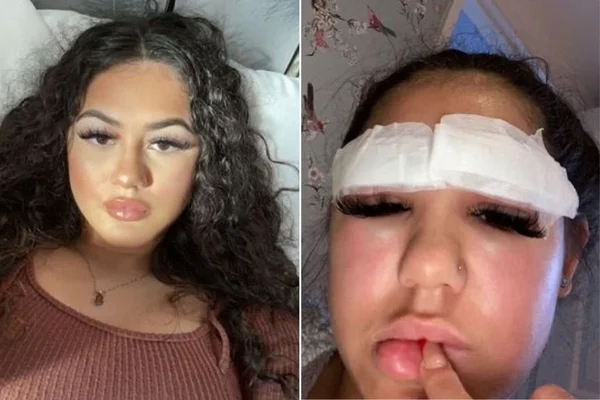 Jovem perde pelos das sobrancelhas após reação alérgica a procedimento