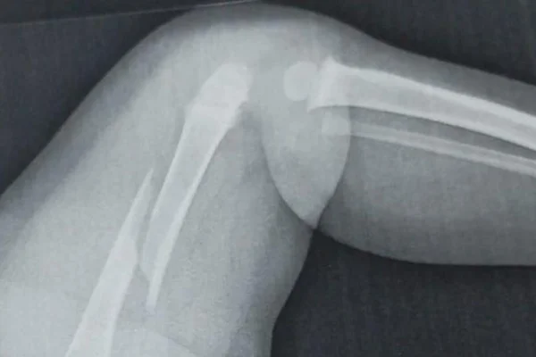 Raio-x mostra femur quebrado de bebê de cinco meses