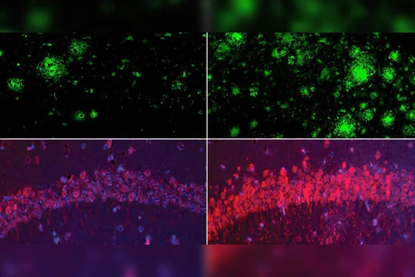 Em um modelo murino de Alzheimer, a deficiência de lítio (à direita) aumentou drasticamente os depósitos de beta-amiloide no cérebro em comparação com camundongos que apresentavam níveis fisiológicos normais de lítio (à esquerda). Linha inferior: O mesmo ocorreu com a proteína tau do emaranhado neurofibrilar do Alzheimer. Metrópoles