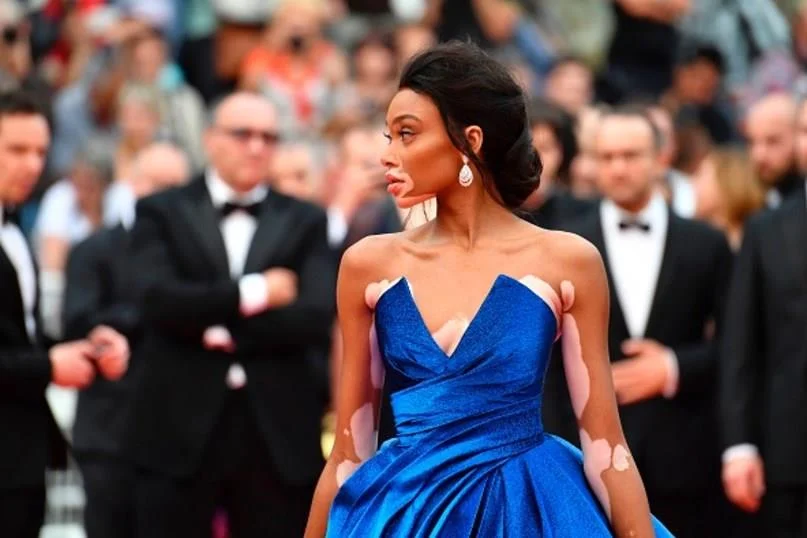 Winnie Harlow Winnie Harlow