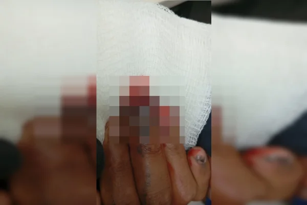 Imagem colorida, borrada, da mão de um adolescente pardo, com um ferimento no dedo anelar
