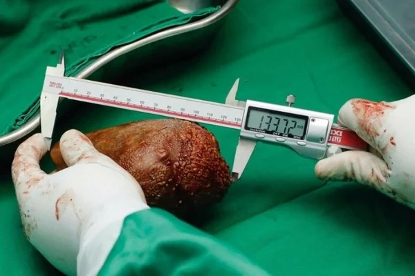 Imagem colorida: médico mede maior pedra nos rins do mundo - Metrópoles