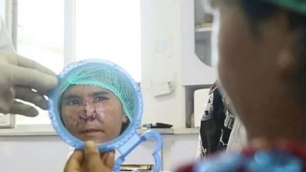 Mulher tem nariz arrancado com canivete pelo marido