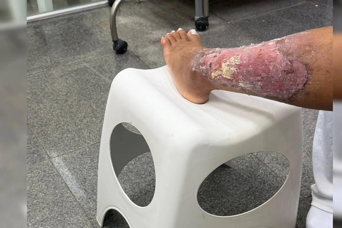 Kenia Alves sofreu queimaduras nas pernas e precisa voltar ao hospital diariamente Kenia Alves sofreu queimaduras nas pernas e precisa voltar ao hospital diariamente