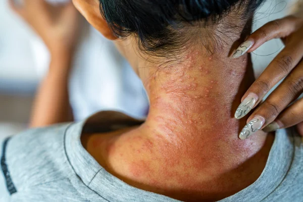 Foto colorida do pescoço de uma mulher com manchas vermelhas. - Metrópoles