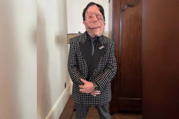 ator britânico Adam Pearson. Ele possui uma doença rara chamada neurofibromatose. Metrópoles