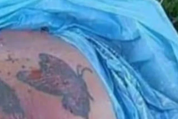 “Corpo” encontrado no DF são restos de pele removidos em cirurgia plástica