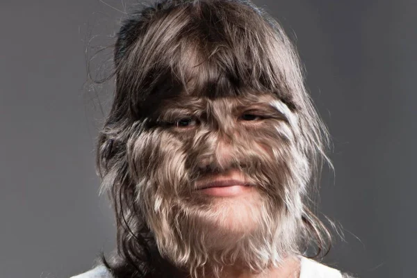 Supatra Nat Sasuphan, Adolescente mais peluda do mundo