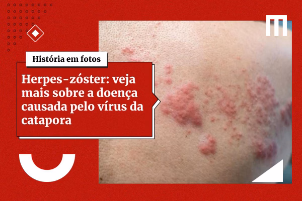 3-Cards_Galeria_de_Fotos-6-24 Vacina contra herpes-zóster reduz risco de AVC e infarto, diz estudo