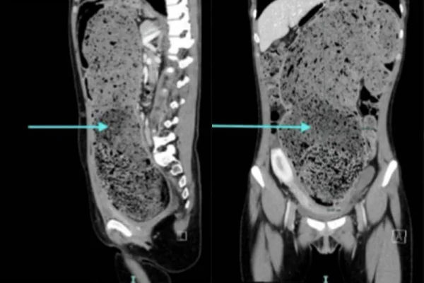 A área marmorizada em seu abdômen é composta de fezes compactadas. mulher constipada. Metrópoles