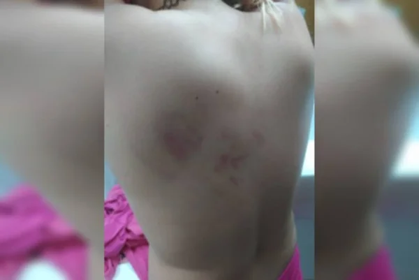 Criança com hematomas
