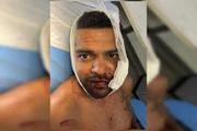 Rafael Moreira precisou de 12 pontos após ser atacado com uma taça de vinho durante confraternização em hotel de Brasília. Rafael Moreira precisou de 12 pontos após ser atacado com uma taça de vinho durante confraternização em hotel de Brasília.