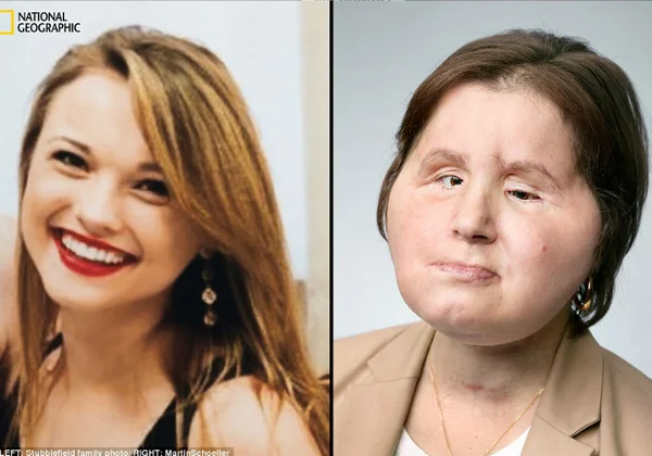 Mulher é a mais jovem a receber transplante de rosto