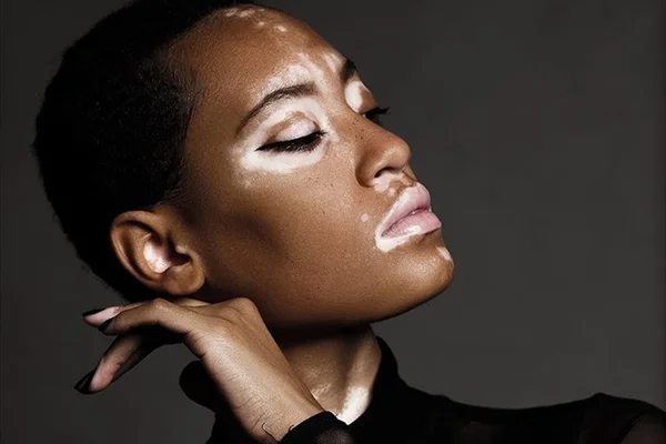 Modelo com vitiligo brilha em nova campanha da CoverGirl