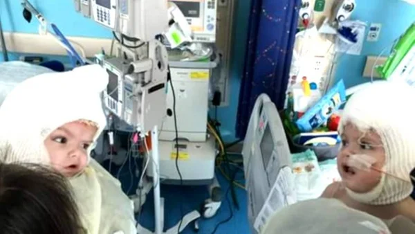 Gêmeos siameses se veem pela primeira vez após cirurgia de separação