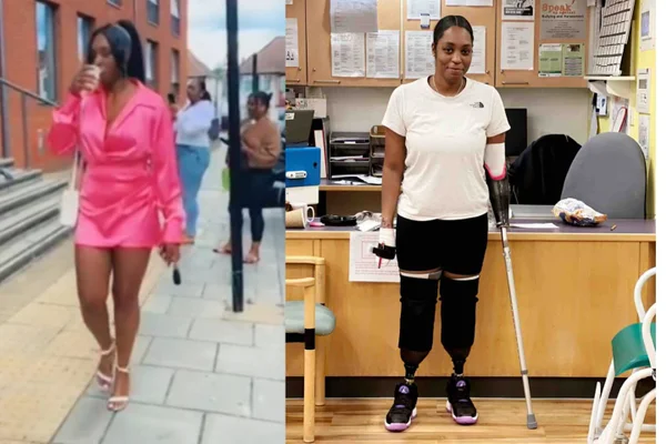 Foto mostra a inglesa Khedidja Teape, de 29 anos, que teve sepse após o parto e teve de fazer amputações