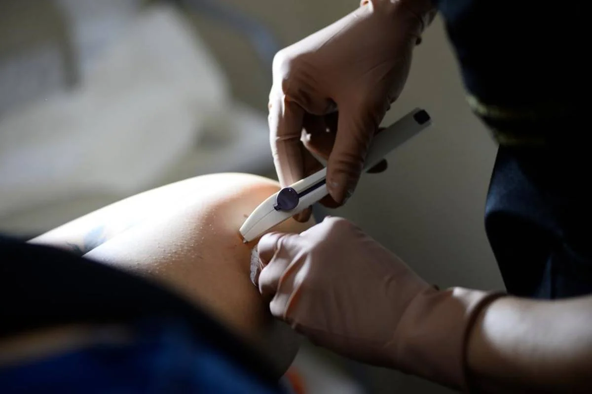Mais de 12mil unidades de Implanon chegam às UBSs do DF: conheça o método contraceptivo