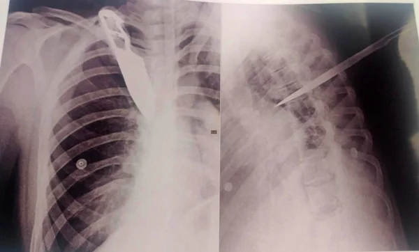 Raio-X mostra a faca cravada no corpo da mulher de 33 anos