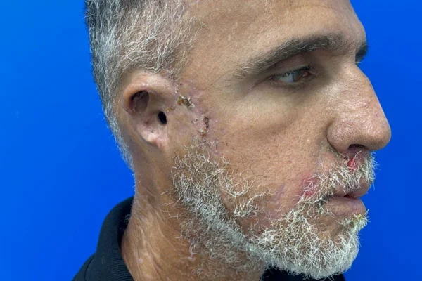 Foto colorida de Wagner Vieira Gomes após cirurgia - Metrópoles
