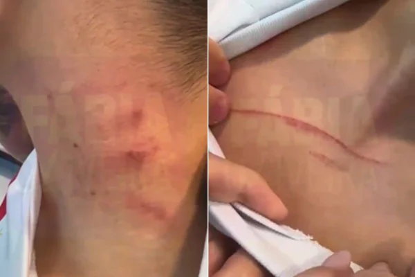 Montagem colorida dos hematomas do jovem - Metrópoles