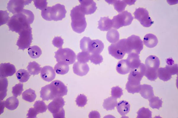Plasmodium falciparum, estágio em anel em hemácias humanas, parasita da malária --- 400X. Parasita protozoário. O vetor é a fêmea do mosquito Anopheles. Espécie mais perigosa de Plasmodium.