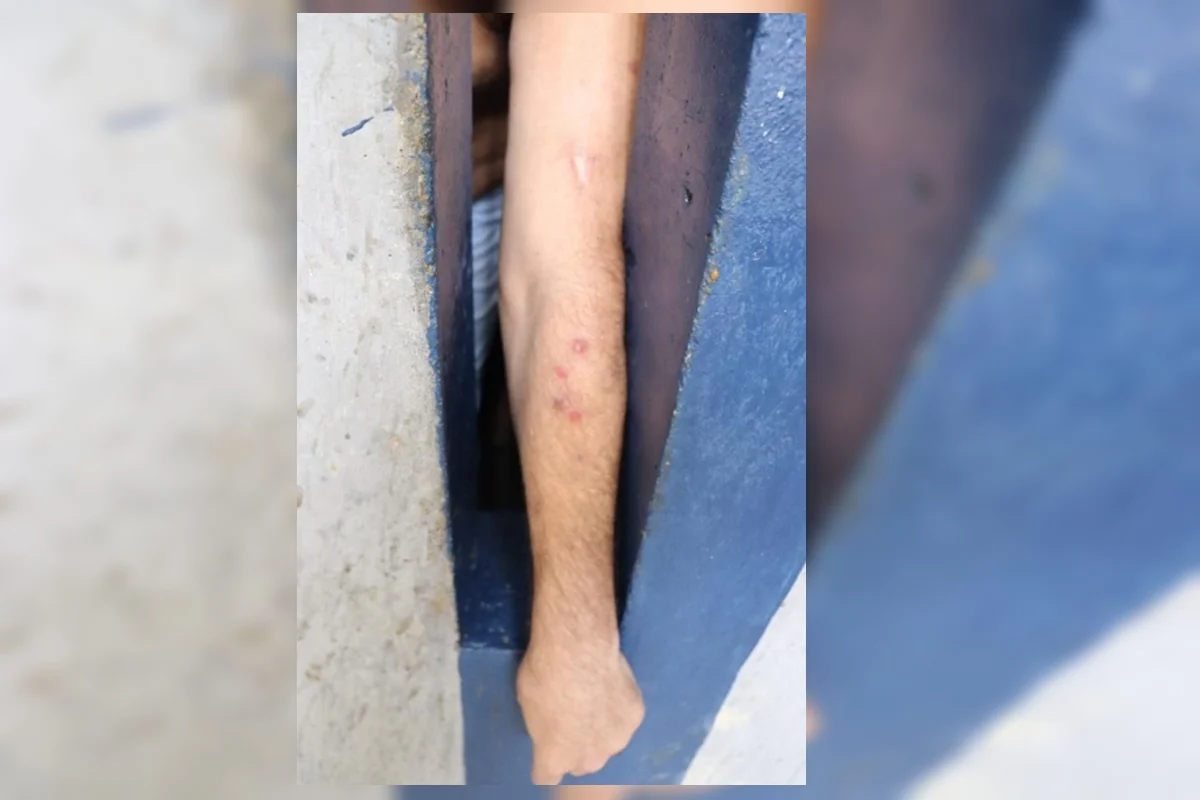 Um detento apresentava picadas de inseto pelo braço Um detento apresentava picadas de inseto pelo braço