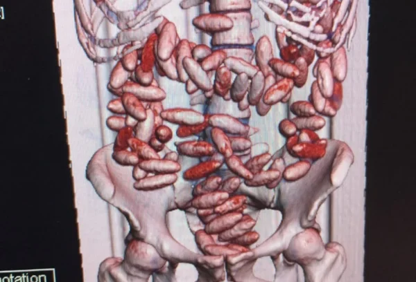 Foto colorida de ressonância que mostra pacotes de cocaína dentro de estômago - Metrópoles