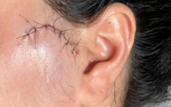 Ferimento no rosto de cabelereira que foi esfaqueada em Uruana, Goiás