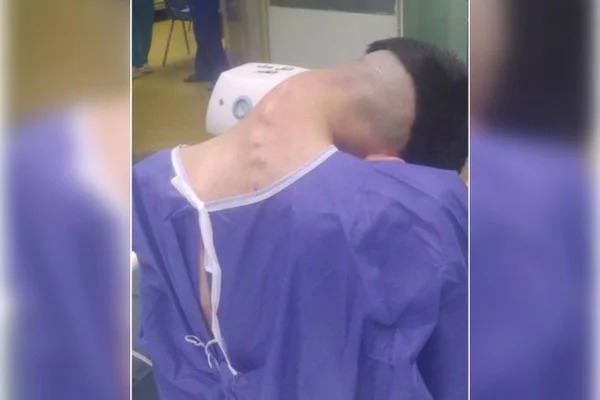 jovem de 23 anos, que não foi identificado, foi fotografado por médicos do Hospital Universitário Al-Zahra, no Irã, que registraram caso raro e grave de "Síndrome da Cabeça Caída". Metrópoles