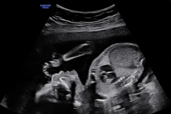 Grávida perde bebê e denuncia hospital por negligência médica
