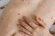 A doença pode se manifestar a qualquer momento em pessoas que já tiveram catapora ou a própria herpes-zóster alguma vez na vida. O vírus permanece inativo no corpo por muitos anos, podendo ser reativado na forma mais localizada em um nervo A doença pode se manifestar a qualquer momento em pessoas que já tiveram catapora ou a própria herpes-zóster alguma vez na vida. O vírus permanece inativo no corpo por muitos anos, podendo ser reativado na forma mais localizada em um nervo