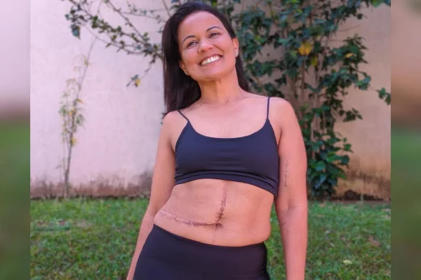 foto colorida de mulher com cicatriz na barriga - Metrópoles