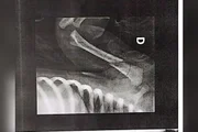 Bebê é levada ao hospital com ossos quebrados e pais são presos - imagem 5 Bebê é levada ao hospital com ossos quebrados e pais são presos - imagem 5