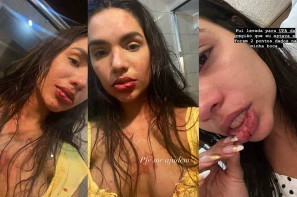 A influenciadora digital Kedma Oliveira mostra marcas da agressão