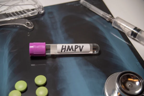 Imagem com teste de hMPV sobre imagem de tomografia de pulmão - Metrópoles
