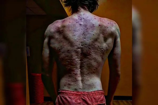 Esteroides deixam jovem com acne tão grave que ele não podia se vestir, anabolizante, espinhas - Metrópoles