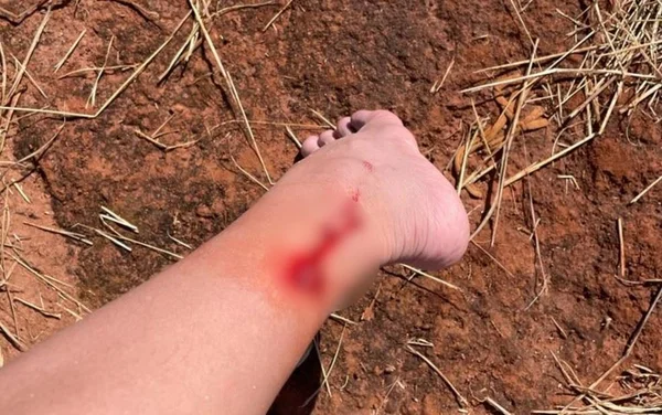 Ferimento na perna de criança causado por piranha, no Lago das Brisas, em Buriti Alaegre, Goiás
