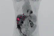 Ressonância que indicou presença de nódulos no fígado transplantado